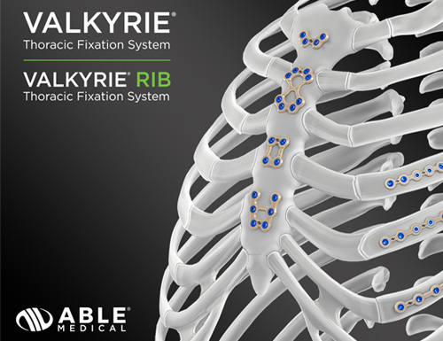 Valkyrie® Thoracic Fixation System surpasses 10,000 procedures in the U.S
